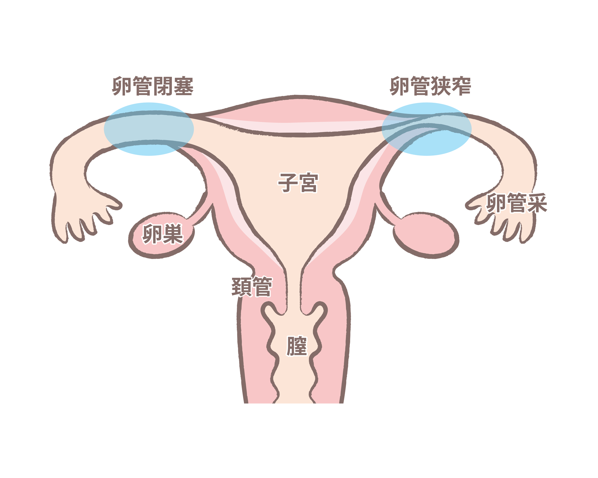 卵管閉塞とは