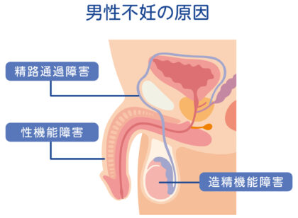 男性不妊の主な原因
