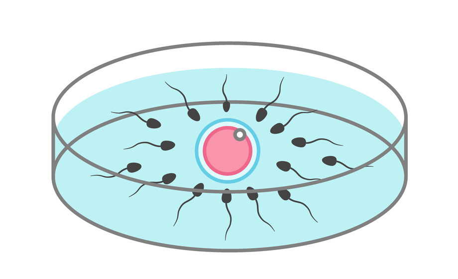 体外受精(IVF)
